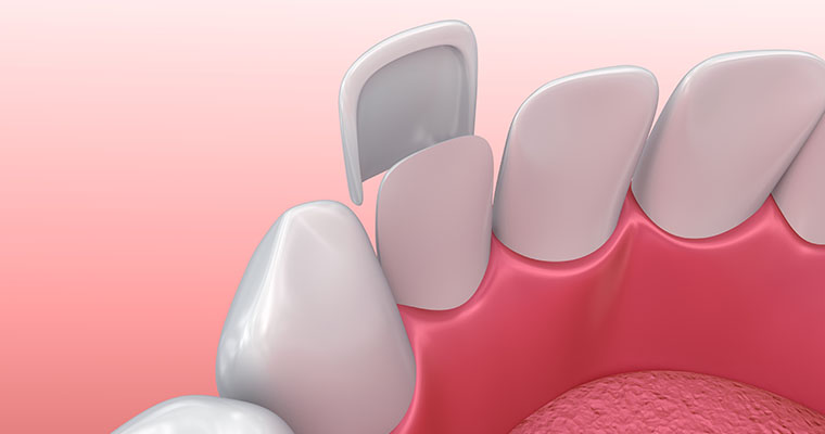 How a veneer fits onto a natural tooth